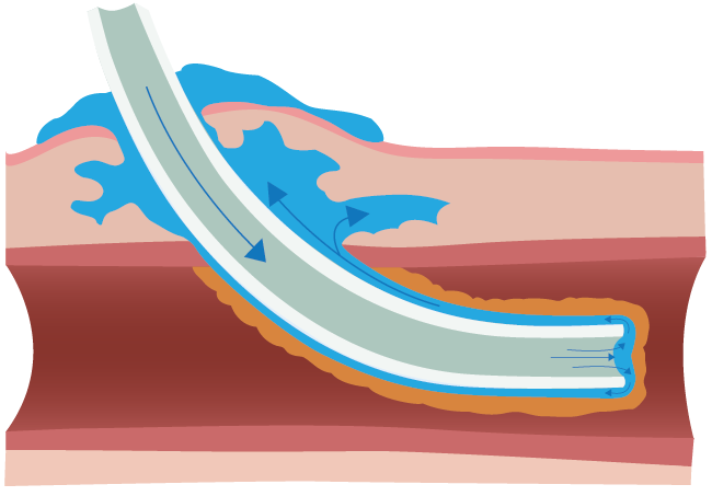 Fibrin Sheath