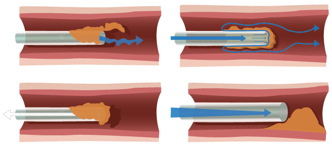 Fibrin Sheath